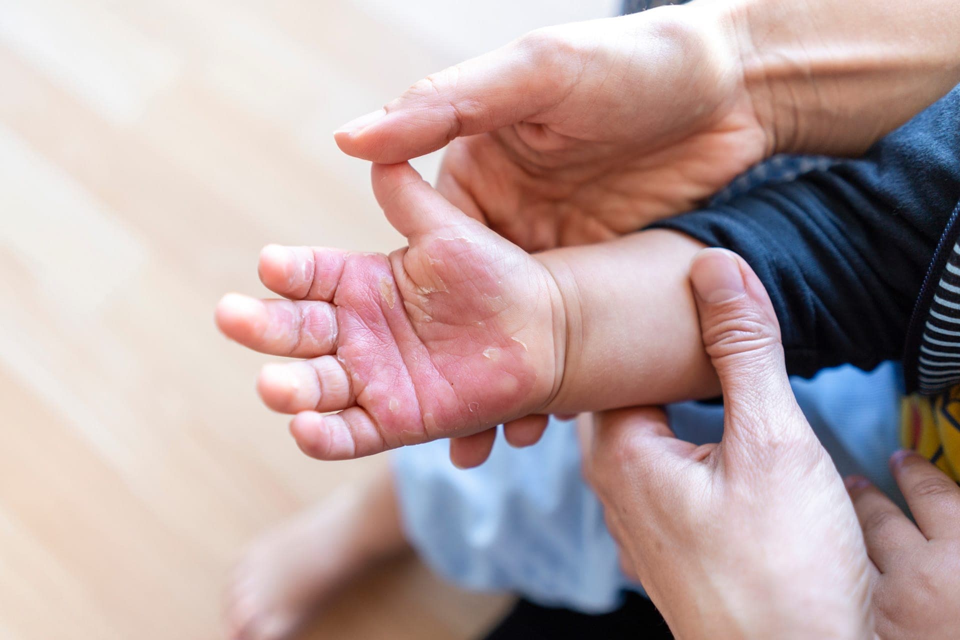 bambino con mano ustionata